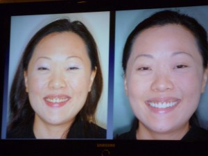 Patient before and after smile rejuvenation