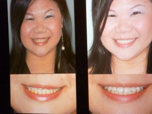 Jenny before and after her temporary smile makeover