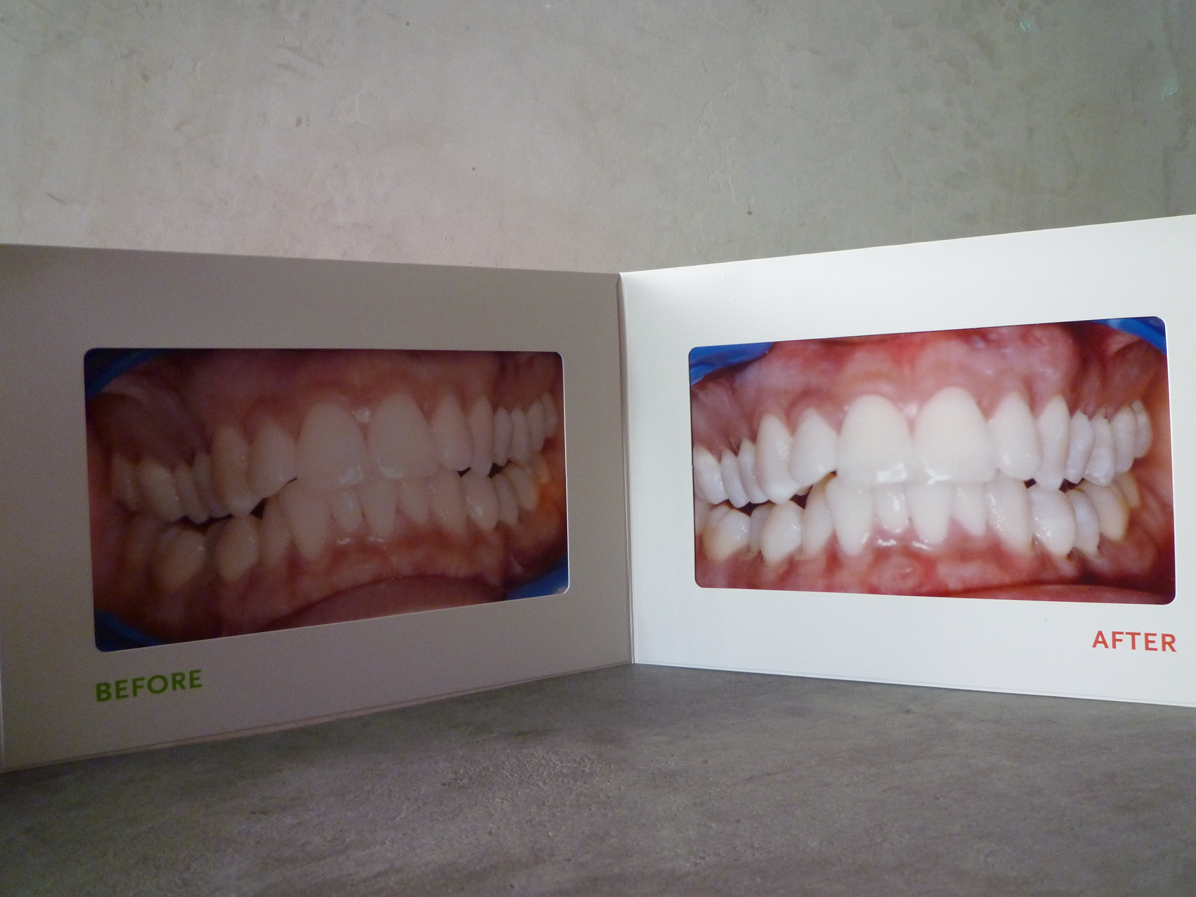 laser teeth whitening