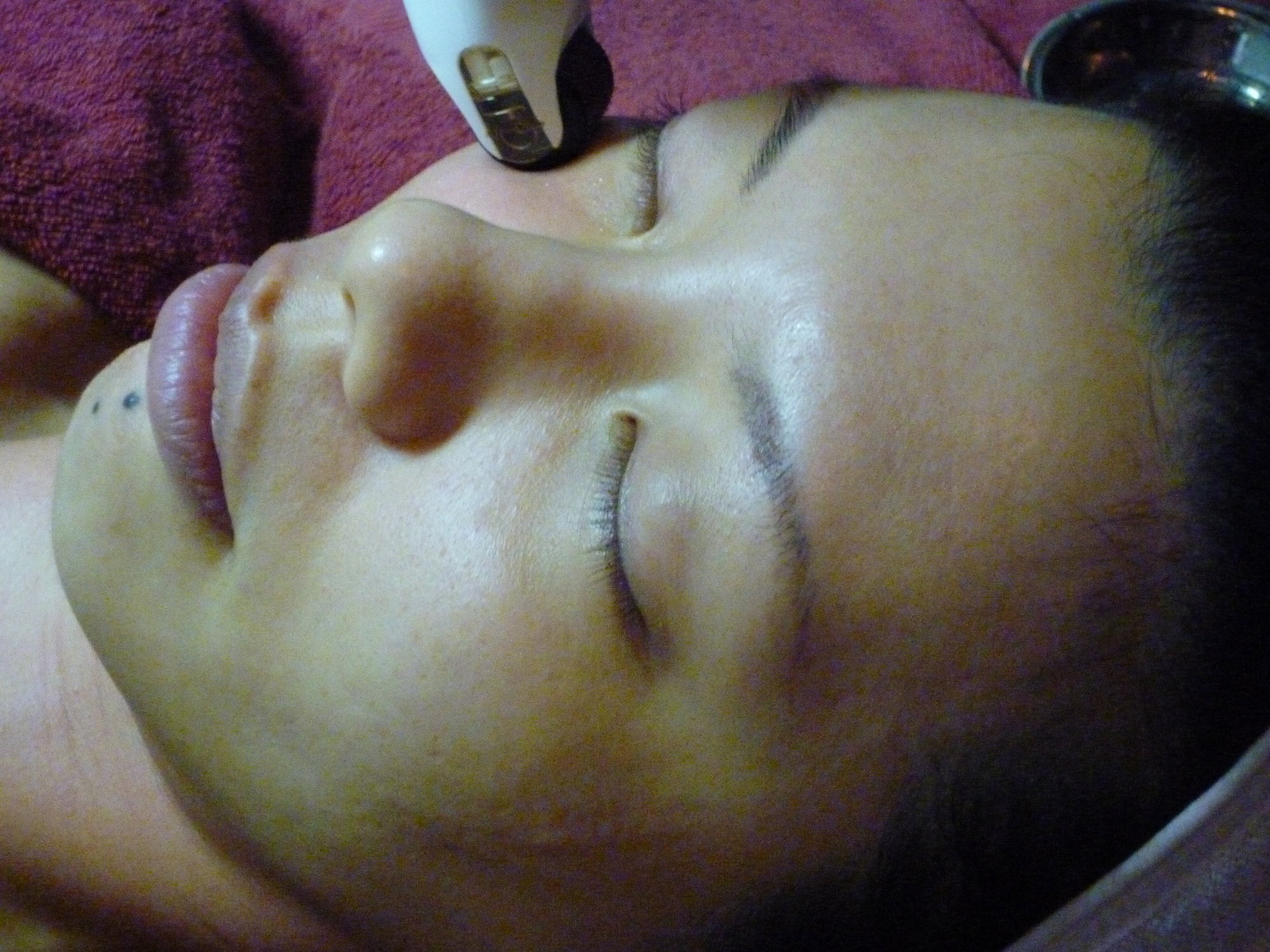 mesotherapy mesotherapy