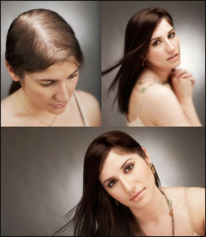 hair loss hair loss