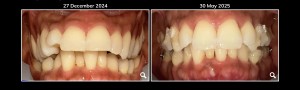 Invisalign update - 5 months after