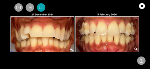12 months with Invisalign and I have straight teeth now!