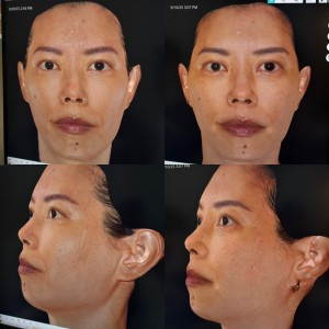 The QuantifiCare 3D imaging system showing my skin in its full (ahem) glory.